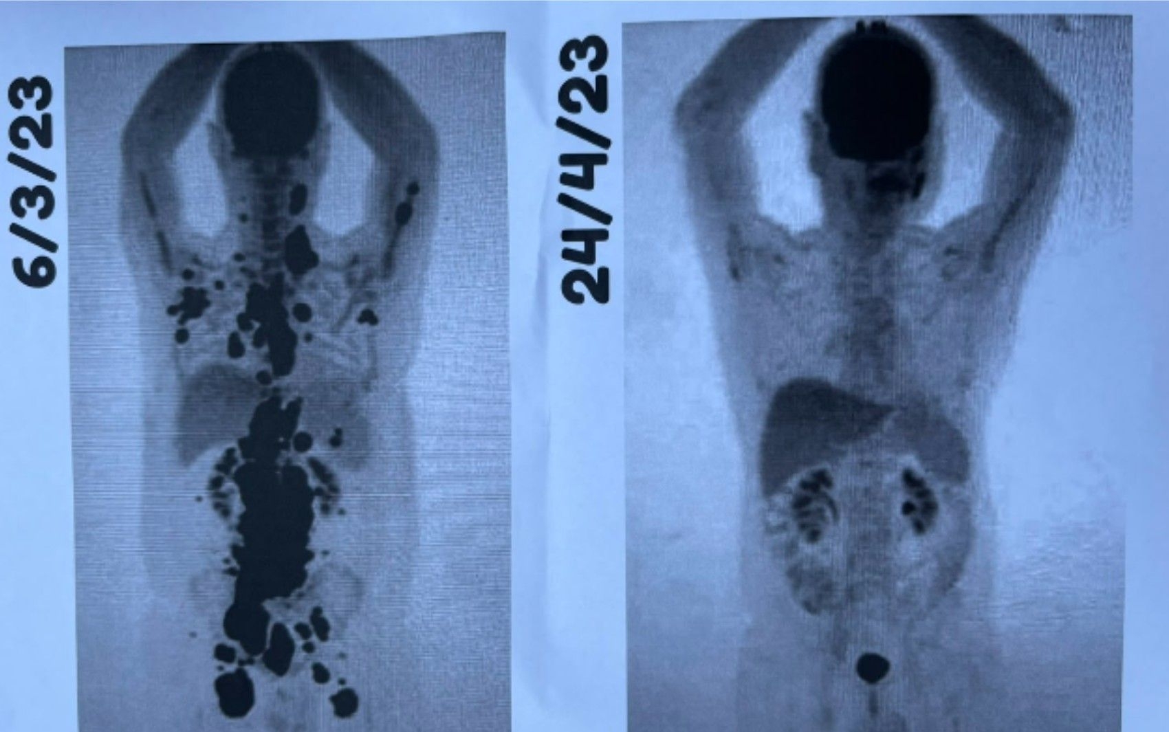 Remissão total do câncer após tratamento CAR-T Cell