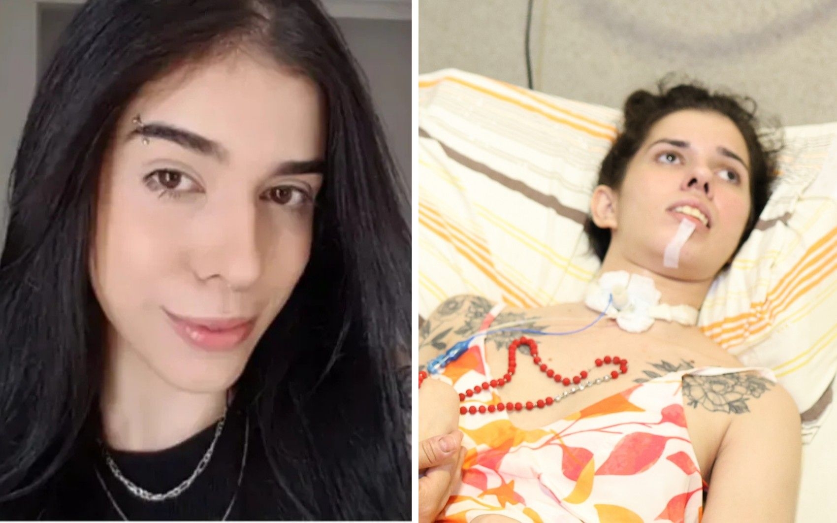 Jovem com reação alérgica grave é internada na UTI novamente