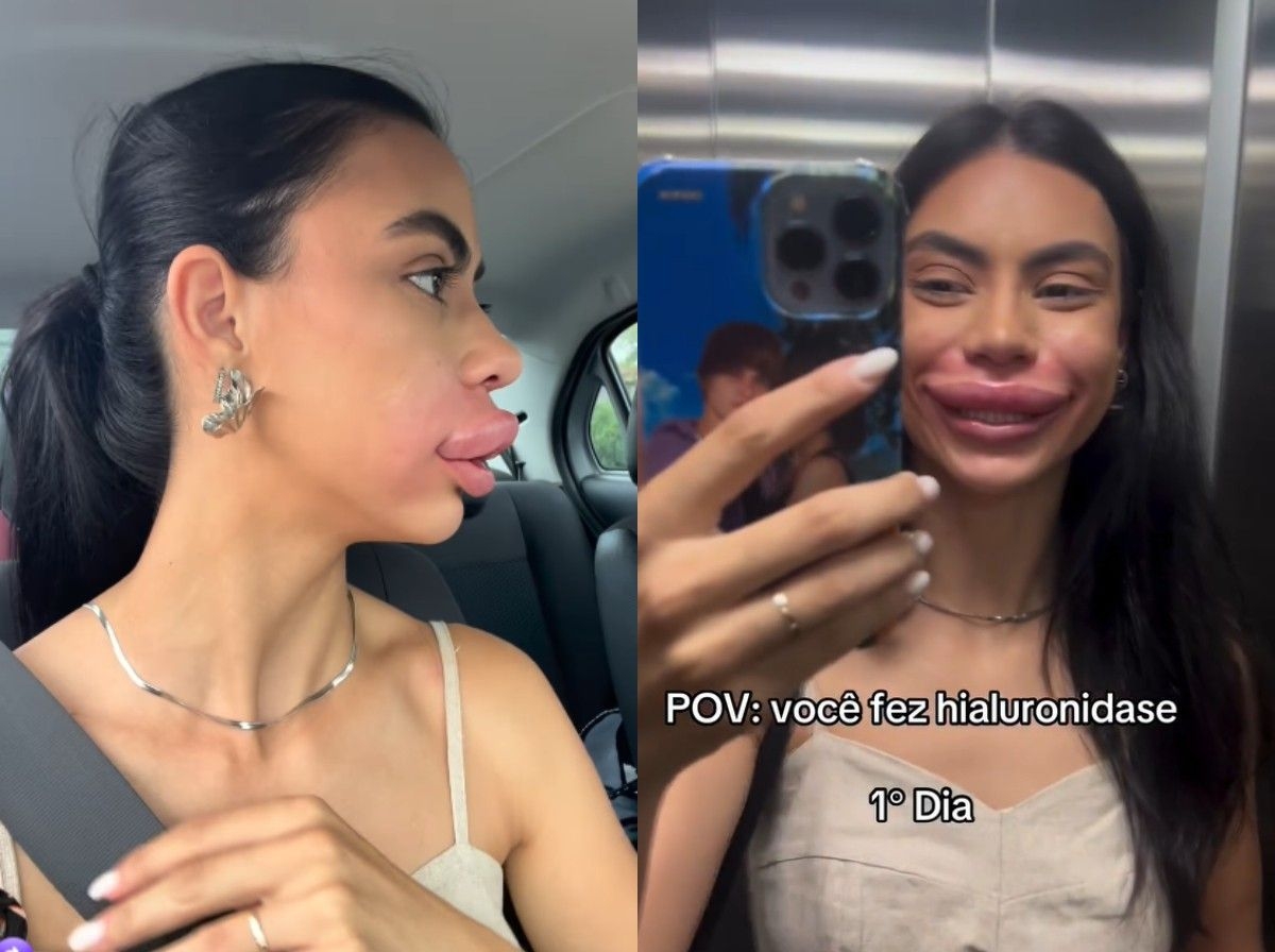 Inchaço nos lábios da Miss Pomerode vira sensação na web