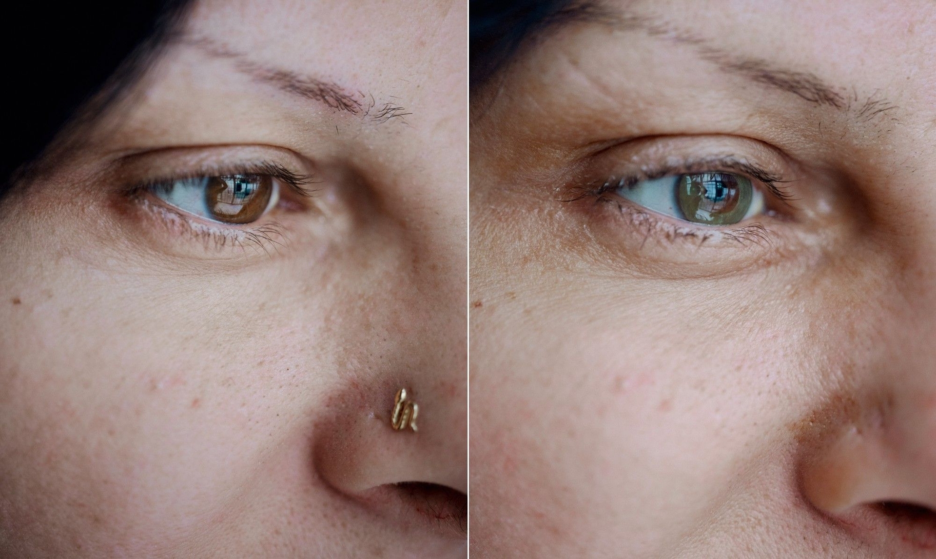 Procedimento revolucionário altera a cor dos olhos